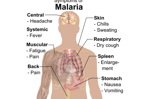Vaccino contro Malaria: perché è un successo con molte preoccupazioni